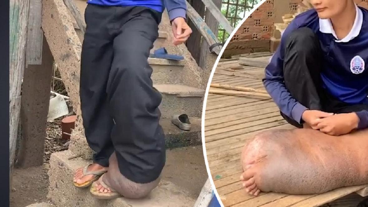 شرایط عجیب پای پسر کامبوجی پس از گزش پشه!