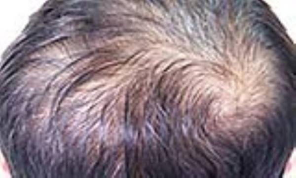 ارتباط بین فقدان ویتامین D و ریزش مو