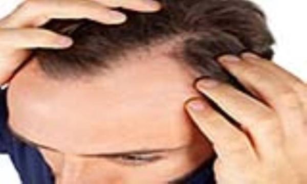 درمان لیزری ریزش مو